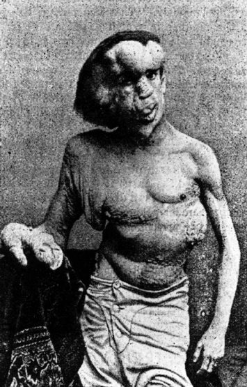elephantman