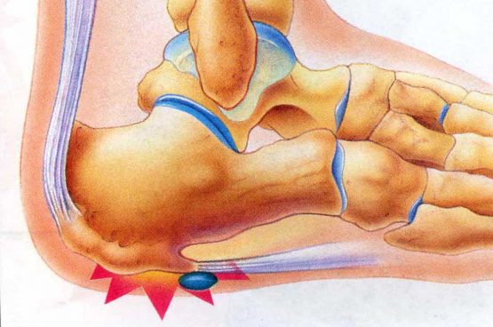 PlantarFasciitis