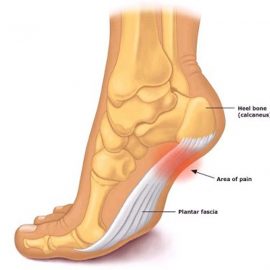 Plantar-Fasciitis